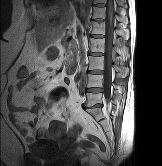 MRI Lumbar Sagittal Neutral Scan (AI Enhanced)